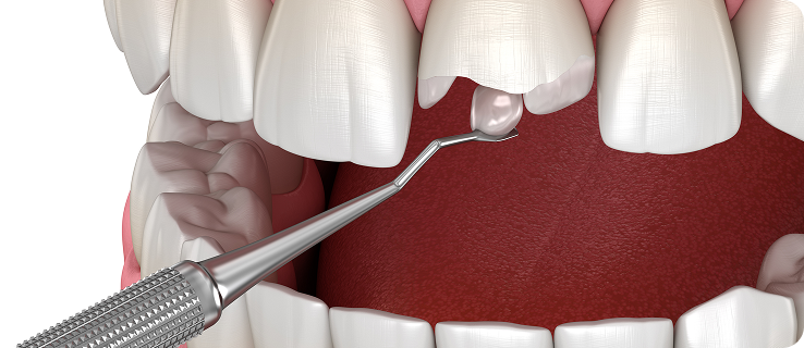 임시 보철물 장착