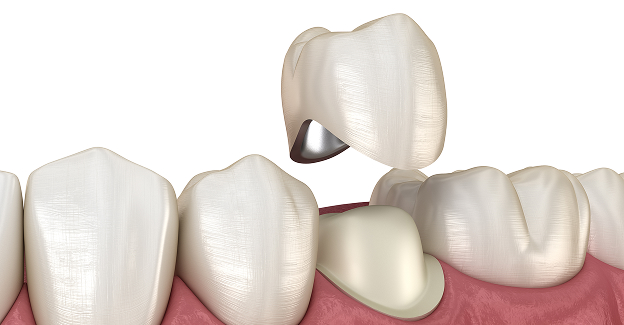 지르코니아 크라운