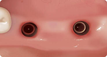 디지털 수술 가이드