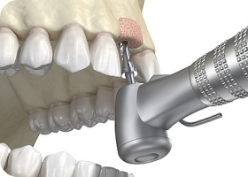 임플란트 치근 식립